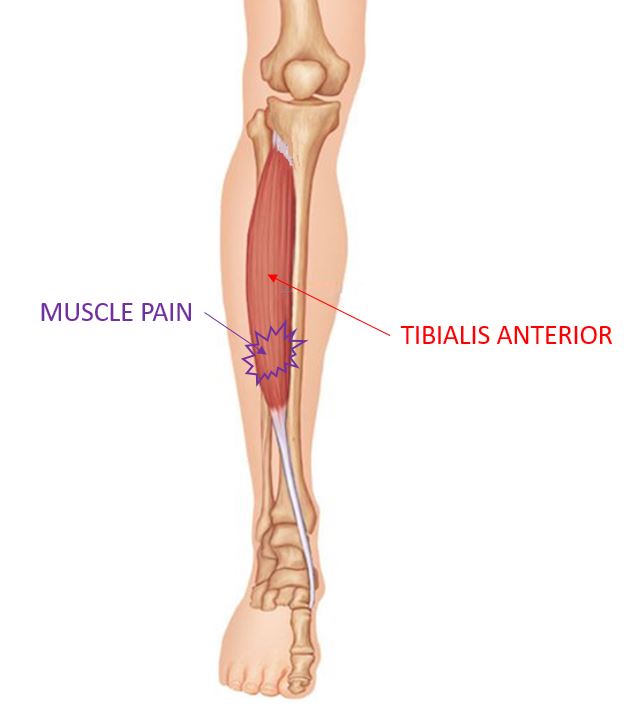 tibialis anterior, shin splints